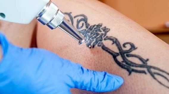 Cómo borrar un tatuaje de juventud: técnica y precios - Uppers